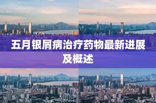 五月銀屑病治療藥物最新進展及概述